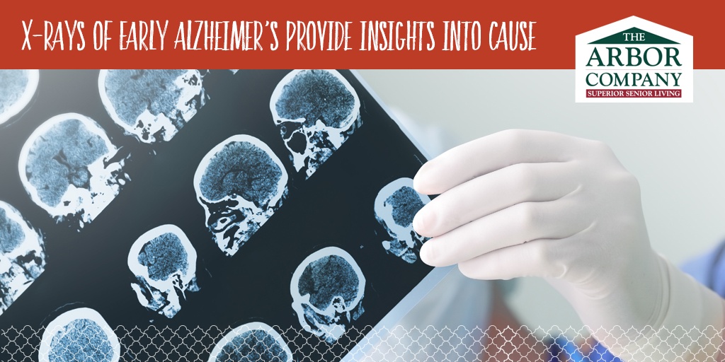 XRays of Early Alzheimer’s Provide Insights into Cause